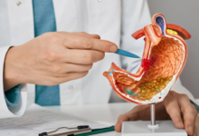 The Psychological Benefits of Gastric Sleeve Surgery for Weight Loss